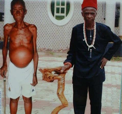 | Nollywood actor down with Liver disease, needs 1 million naira for