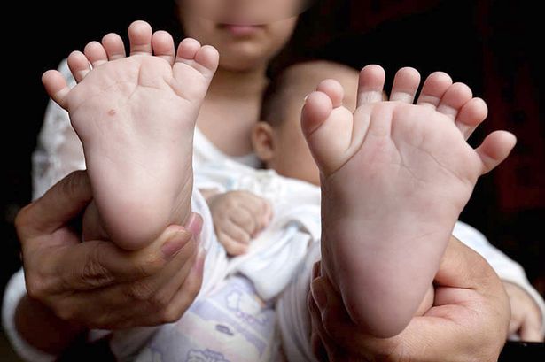 Hong-Hong-baby-born-with-15-fingers-and-16-toes